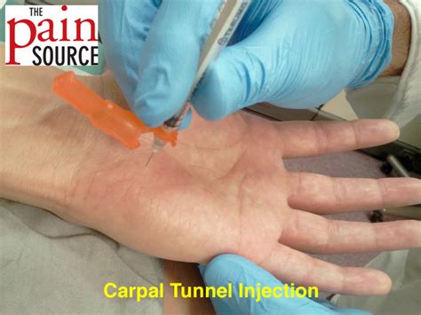 Carpal Tunnel Injection Technique And Tips The Pain Source Makes