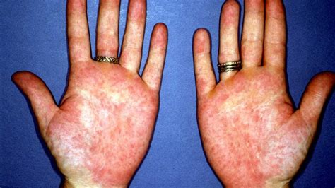Rheumatoid Arthritis Rash Causes Symptoms And Images