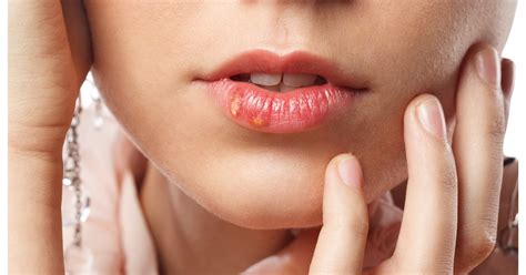 how to get rid of a fever blister on a lip livestrong