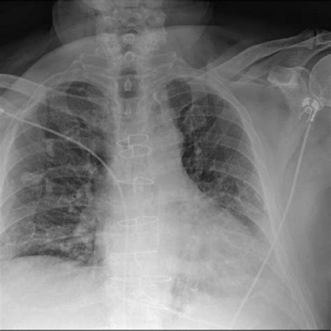 Chest X Ray On Hospital Day Showing Possible Left Lower Lobe Pneumonia Download Scientific