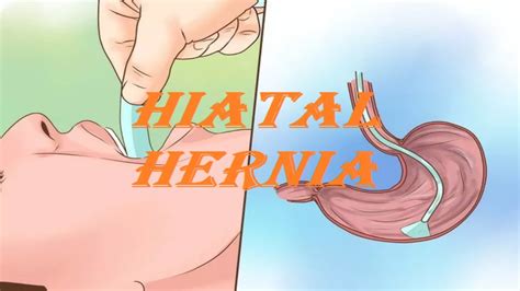 Hiatal Hernia How To Treat A Hiatal Hernia Youtube