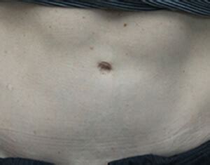 1200 x 375 jpeg 110 кб. Belly Button Surgery | Umbilicoplasty - Dr. Christine Hamori - Boston South Shore