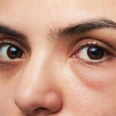 Discover More Than Treatments For Bags Under Eyes Latest In Duhocakina