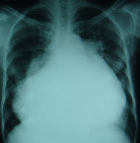 Gross Cardiomegaly On Chest X Ray Pa View All About Cardiovascular