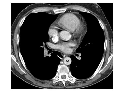Dilated Thoracic Duct Mimicking A Left Supraclavicular Mass Eurorad