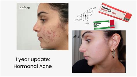 Spironolactone 1 Year Later Before And After Pictures Hormonal Acne