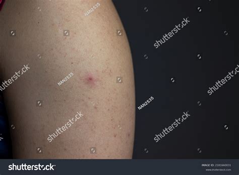 Acne On Upper Arm Rash Skin Stock Photo 2181660031 Shutterstock