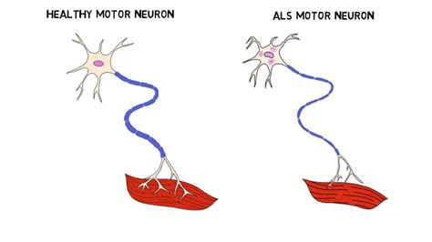 Amyotrophic Lateral Sclerosis Causes Symptoms Treatment Prevention