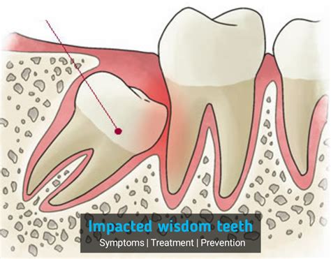 What Are Impacted Wisdom Teeth Symtoms Treatment And Prevention