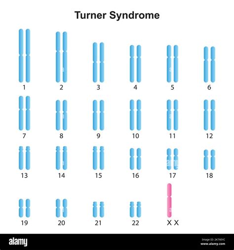 Turner syndrome karyotype Banque d images détourées Alamy