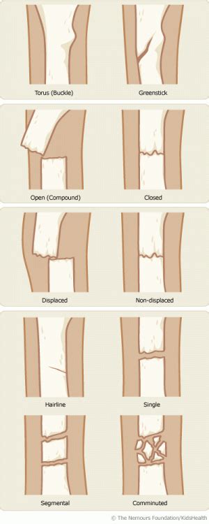 Different Types Of Bone Fractures