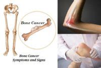 Common bone cancer symptoms arise in the dissemination process, and expressed in terms of weight loss and increased fatigue. Bone Cancer Signs, Symptoms, and Treatment | Tumor & Cancer