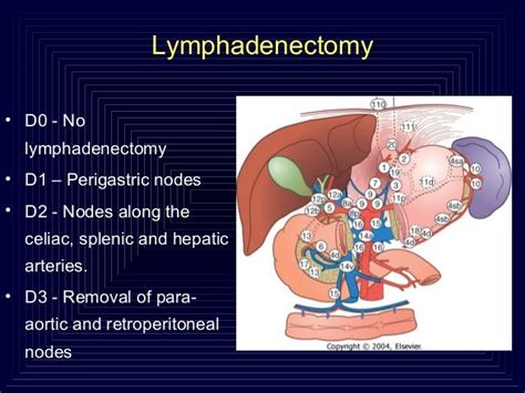 Laparoscopic Gastrectomies For Cancer