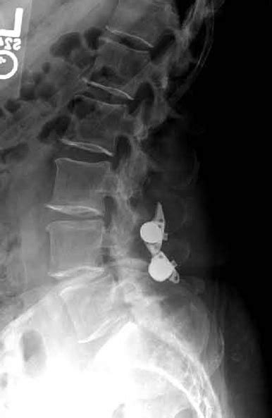 Keep a healthy back schedule and healthy habits. Lumbar Spinal Stenosis with Spondylolisthesis