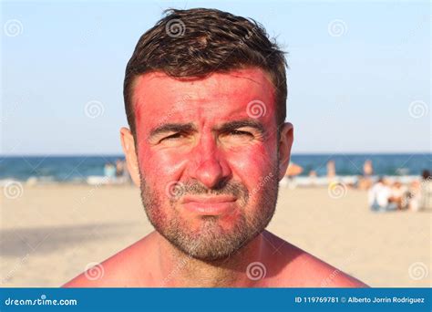 Man Getting Sunburned At The Beach Stock Image Image Of Cancer Beach