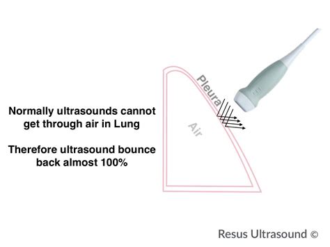 Simplified Lung Ultrasound