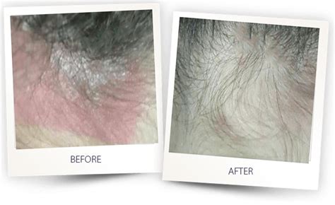 Psoriasis Laser Treatment Focused Uvb Light Therapy