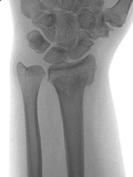 Distal Radius Osteotomy Franko East Bay Hand Medical Center Best