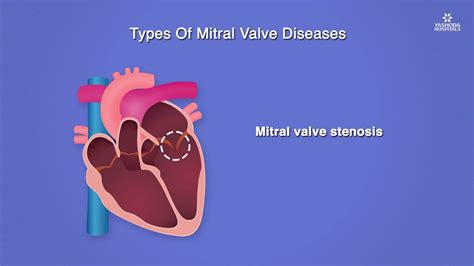 Transcatheter Mitral Valve Replacement Tmvr For Mitral Valve Diseases