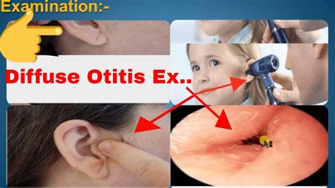 Diffuse Otitis Externapev Acute And Chronic With Signs Symptoms