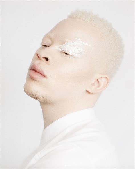 On The African Continent Discrimination Against People With Albinism Is Intensifying — The Jfa