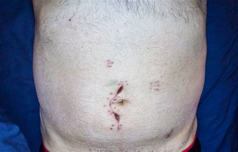Skin Incision Stock Photos Pictures And Royalty Free Images Istock