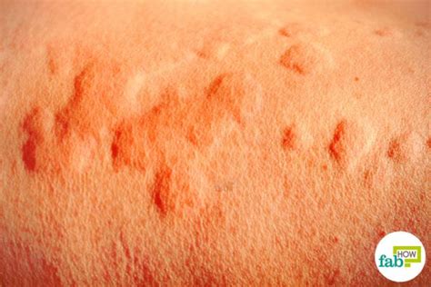 How does stress cause a rash? How to Get Rid of Hives Fast with Home Remedies | Fab How