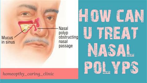 What Do Nasal Polyps Look Like