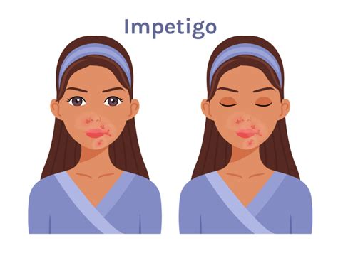 Impetigo What Does It Look Like And What Should You Do American