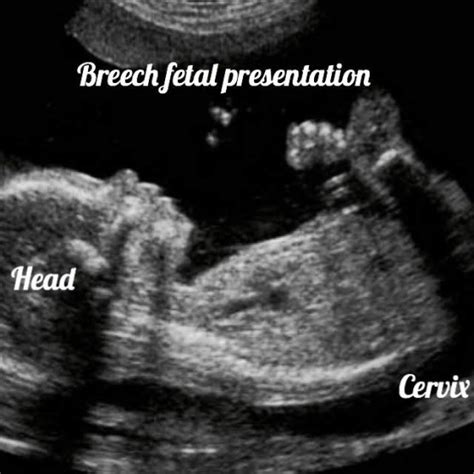 Normal 36 Weeks Pregnancy And Ultrasound Your Complete Guide