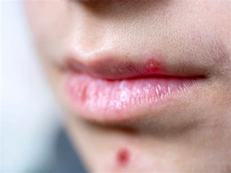 Red Bumps On Lips Treatment