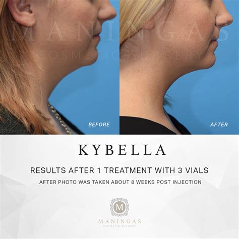 Kybella An Fda Approved Non Surgical Injection To Address Submental