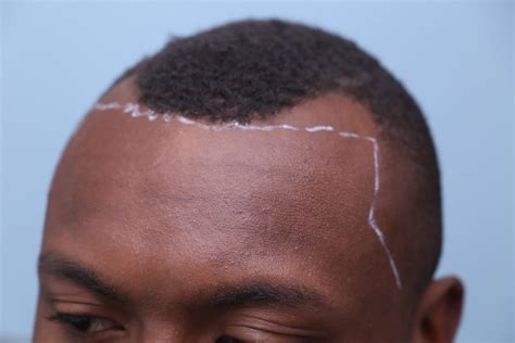 Before And After Fue Hair Transplant One Procedure Months
