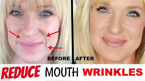 Get Rid Of Mouth Wrinkles Without Fillers Youtube Mouth Wrinkles