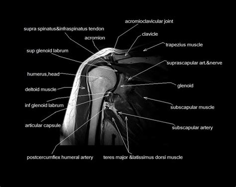 Axial slice of t1 weighted mri with all anatomical structures labeled. MRI shoulder anatomy | shoulder coronal anatomy | free ...