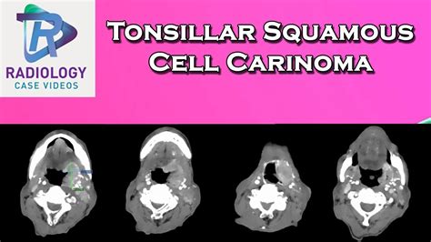 Tonsillar Squamous Cell Carinoma Youtube