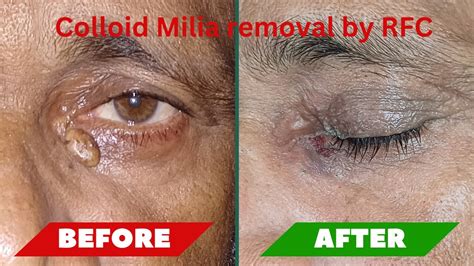 Colloid Milia Removal By Rfc By Mbbs Md Dermatologist Dr Uttam Ku