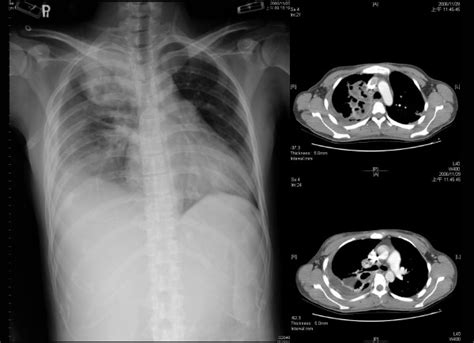 The Chest Radiograph And Computed Tomography Showed Pleural Empyema