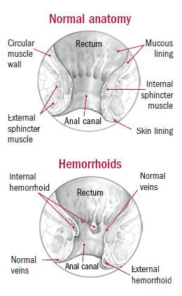 Ance regarding outcomes after surgical treatment. What can I do to ease the discomfort of hemorrhoids? - Ask ...