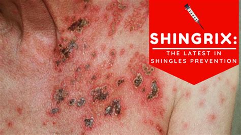 Shingrix The Latest In Shingles Prevention