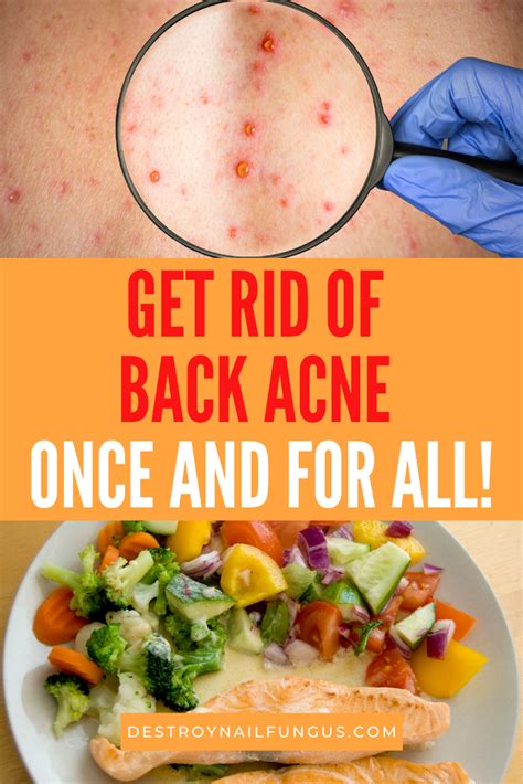 How To Get Rid Of Back Acne Common Remedies That Do Wonders