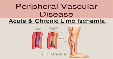Peripheral Vascular Disease Acute And Chronic Limb Ischemia Lipi Shukla
