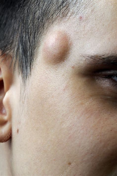 Sebaceous Cyst On The Face Stock Image C0225514 Science Photo