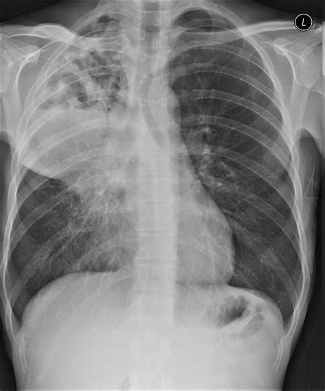 Lung Abscess X Ray