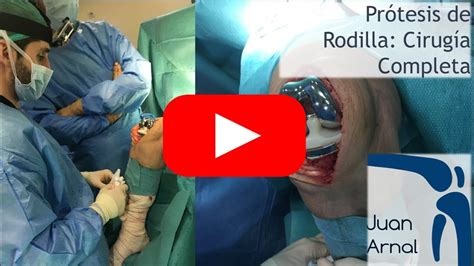 Protesis De Rodilla Cirugía Completa Youtube