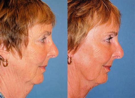 Patient 122406512 Profile Neck Lift Before And After Photos Clevens