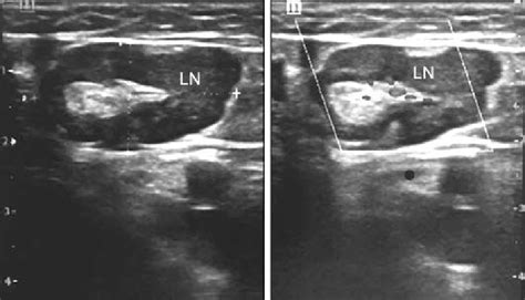 A And B Hyperechoic Fatty Hilum In A Cervical Lymph Node Left Panel
