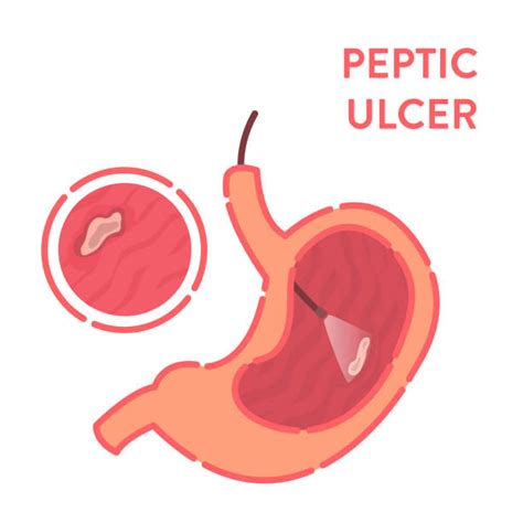 Peptic Ulcer Stomach Disease Endoscopy Diagnostic Infographics Image