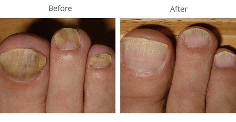 The Truth About Toenail Fungus Treatment Pure Skin Aesthetic Laser
