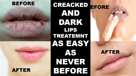 Cracked lips treatment ayurvedic - Dark lips treatment at home 